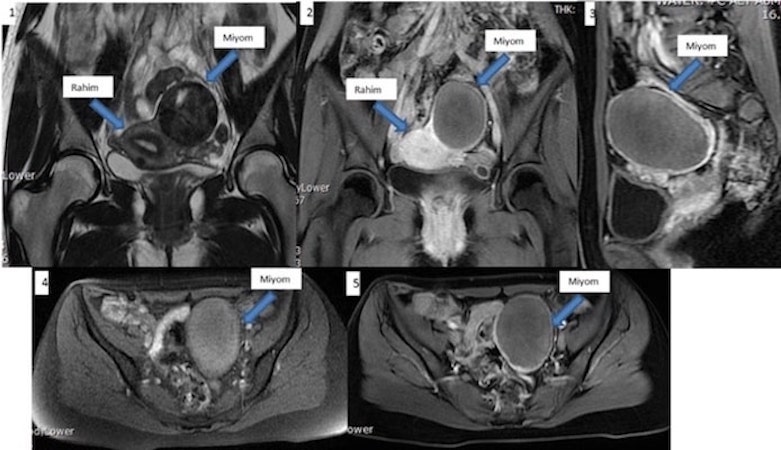 pelvik MR ile miyom-mutlucihangiroglu.com.jpg